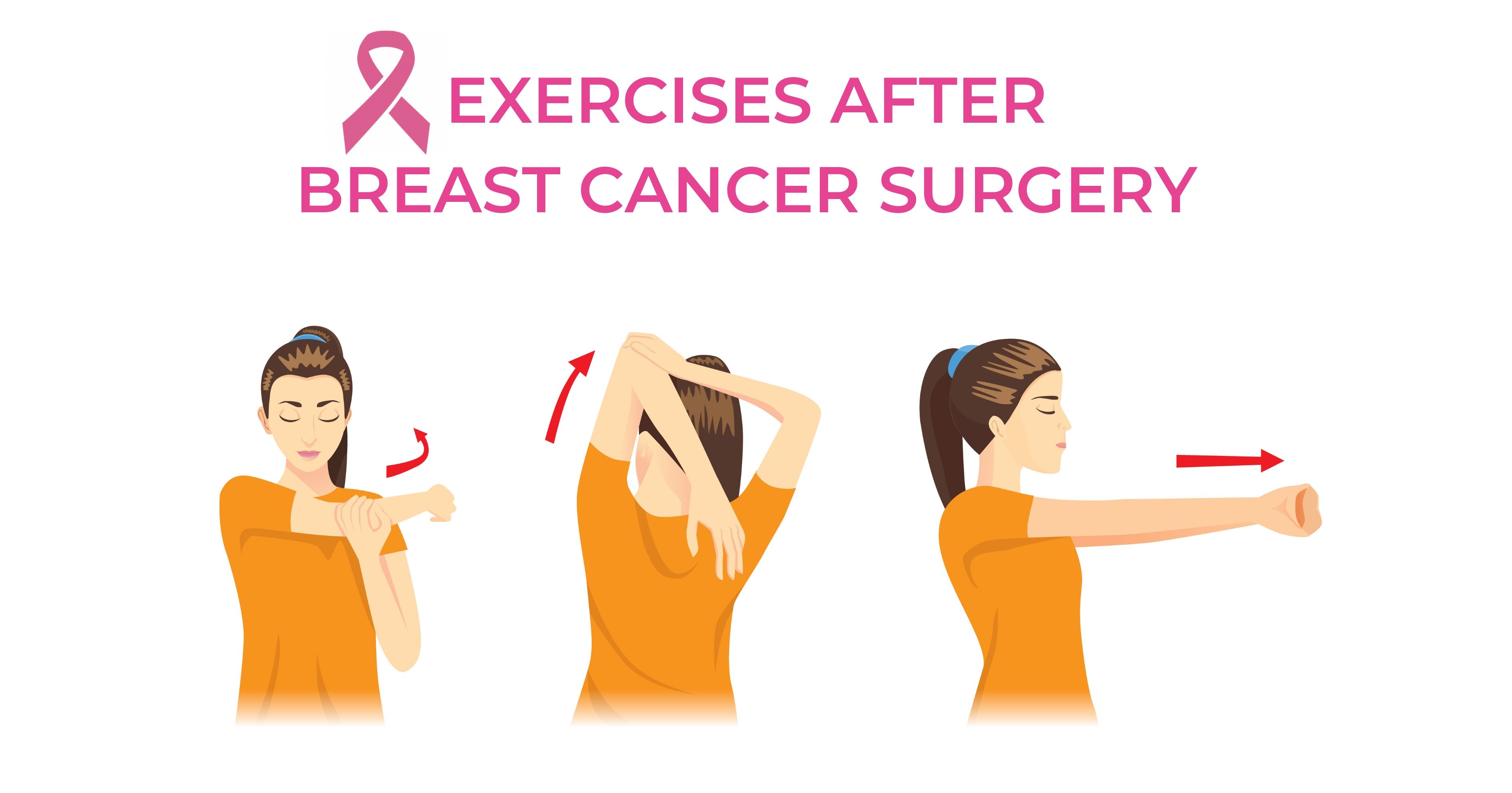 Exercises after breast cancer surgery