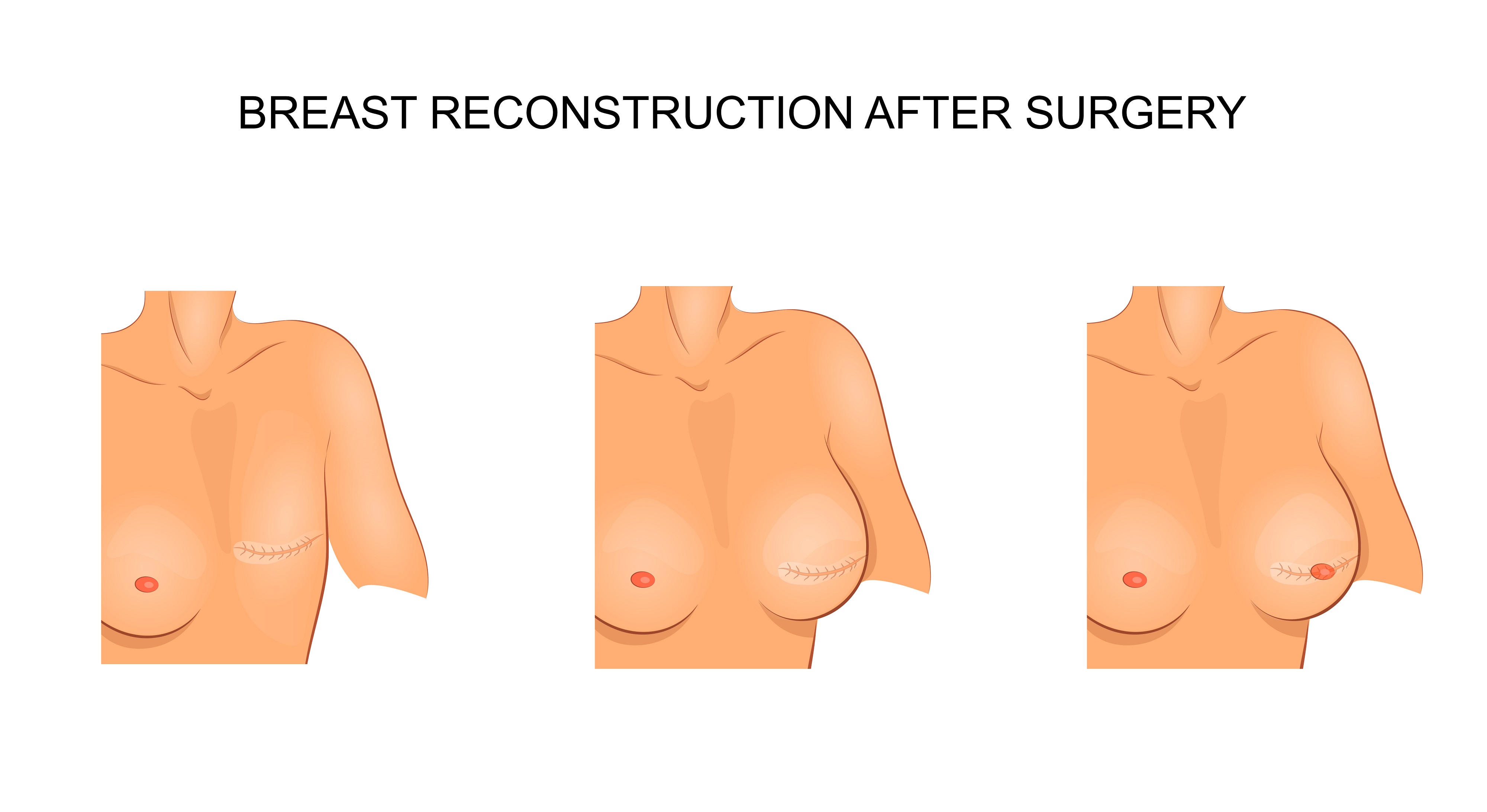 Artificial Symmetrical Breast Triangular Mastectomy Prosthesis
